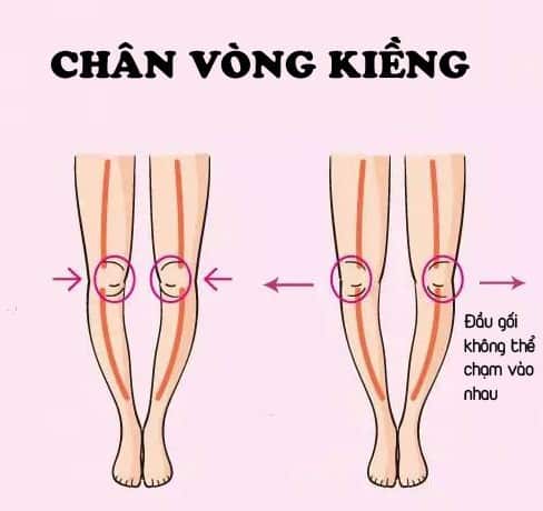 chân vòng kiềng, vòng kiềng, tướng số, tử vi